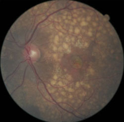 The right (top) and left (bottom) eyes of a 57-year-old African American woman with 20/200 OD and 20/60 OS visual acuity.