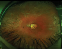 The ultra-widefield autofluorescent images reveal symmetric findings in each eye that are characteristic of inherited retinal degenerations. The macula region of both eyes is hypo-AF and is surrounded by a hyper-AF annulus, suggesting that the macula lesions will enlarge in time. The far peripheral retina reveals various depths of hypo-AF lesions and also has a hyper-AF border nasally, suggesting that it, too, is enlarging. The midperipheral retinal zones reveal the normal AF glow. Vision will be further compromised, as the macula lesions expand outwardly and the far peripheral areas of degeneration expand inwardly. 