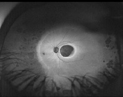 The ultra-widefield autofluorescent images reveal symmetric findings in each eye that are characteristic of inherited retinal degenerations. The macula region of both eyes is hypo-AF and is surrounded by a hyper-AF annulus, suggesting that the macula lesions will enlarge in time. The far peripheral retina reveals various depths of hypo-AF lesions and also has a hyper-AF border nasally, suggesting that it, too, is enlarging. The midperipheral retinal zones reveal the normal AF glow. Vision will be further compromised, as the macula lesions expand outwardly and the far peripheral areas of degeneration expand inwardly. 