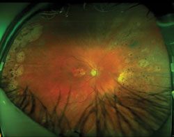 The ultra-widefield autofluorescent images reveal symmetric findings in each eye that are characteristic of inherited retinal degenerations. The macula region of both eyes is hypo-AF and is surrounded by a hyper-AF annulus, suggesting that the macula lesions will enlarge in time. The far peripheral retina reveals various depths of hypo-AF lesions and also has a hyper-AF border nasally, suggesting that it, too, is enlarging. The midperipheral retinal zones reveal the normal AF glow. Vision will be further compromised, as the macula lesions expand outwardly and the far peripheral areas of degeneration expand inwardly. 