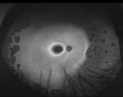 The ultra-widefield autofluorescent images reveal symmetric findings in each eye that are characteristic of inherited retinal degenerations. The macula region of both eyes is hypo-AF and is surrounded by a hyper-AF annulus, suggesting that the macula lesions will enlarge in time. The far peripheral retina reveals various depths of hypo-AF lesions and also has a hyper-AF border nasally, suggesting that it, too, is enlarging. The midperipheral retinal zones reveal the normal AF glow. Vision will be further compromised, as the macula lesions expand outwardly and the far peripheral areas of degeneration expand inwardly. 