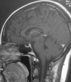 Sagittal T1-weighted MRI revealing an empty sella, with contrast.