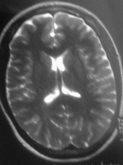 Axial T2-weighted MRI.