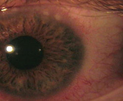 The left eye revealed 2+ injection, string-like discharge and grayish-white raised areas around the corneal margins.