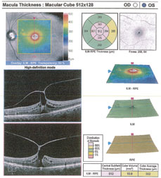 This macular OCT, performed in a patient prior to cataract surgery, uncovered an astonishing presentation of vitreomacular traction.