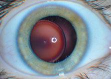 This 11-year-old boy was diagnosed with Marfan syndrome. The patient’s manifest refraction in the right eye was –10.50 D –0.25 D x 180, with a visual acuity of 20/40-2 and in the left eye was –8.50 D –2.00 D x 170, with a visual acuity of 20/25+1. 