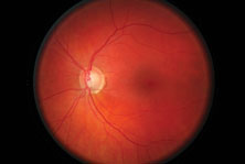 If the appearance of the optic nerve indicates glaucoma, if the patient has hypertension and if he or she admits to excessive daytime sleepiness, the clinician should order a sleep study.