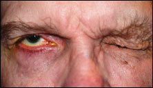 Image of the patient when he was asked to shut his eyes tightly. Note the absence of a Bell’s phenomenon of the right eye.