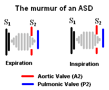 ASD murmur