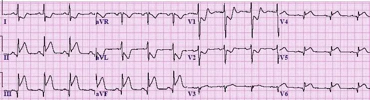 InferiorPosteriorSTEMI-Blog4