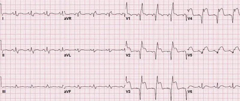 AnteriorSTEMI-RBBB-Blog