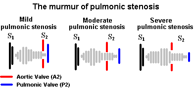 pulmonic stenosis murmur