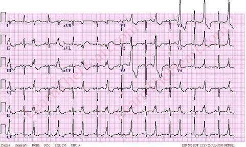 Ventricular Bigeminy ECG