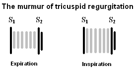 tricuspid regurgitation murmur