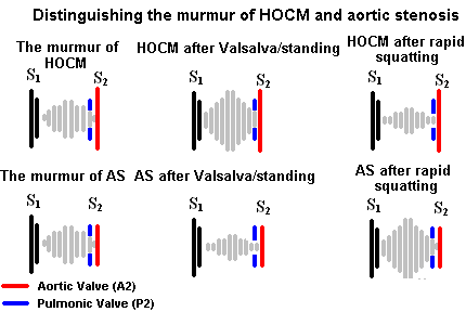 HOCM and aortic stenosis murmur