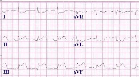 InferiorSTEMI-Blog3