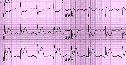 InferiorSTEMI-Blog1