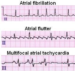 irregularly irregular rhythms