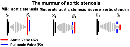 aortic stenosis murmur