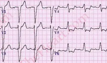 LBBB-PrecordialLeads