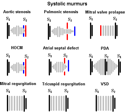 systolic murmurs