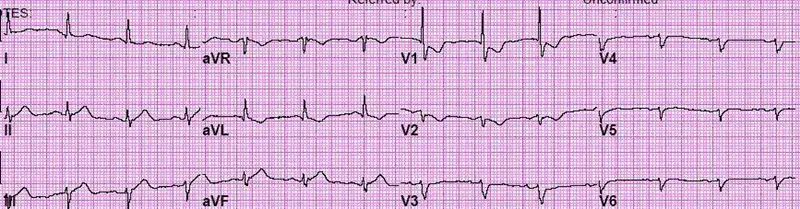 PosteriorMIECG-Blog1