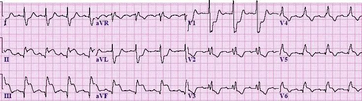 InferiorSTEMI-RBBB-Blog