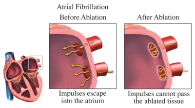 before and after ablation