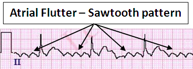 atrial flutter sawtooth pattern