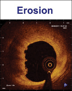 Figure 2. OCT characteristics of the three main mechanisms of ACS. LEFT: Plaque rupture characterized by disrupted thin fibrous cap and cavity formation within the underlying lipid plaque. CENTER: Plaque erosion characterized by relatively preserved vascular integrity and luminal area without cap disruption and overlying residual red thrombus. RIGHT: Protruding calcified nodule characterized by a nodular calcification protruding into the lumen through a disrupted fibrous cap.