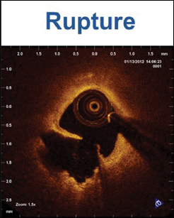 Figure 2. OCT characteristics of the three main mechanisms of ACS. LEFT: Plaque rupture characterized by disrupted thin fibrous cap and cavity formation within the underlying lipid plaque. CENTER: Plaque erosion characterized by relatively preserved vascular integrity and luminal area without cap disruption and overlying residual red thrombus. RIGHT: Protruding calcified nodule characterized by a nodular calcification protruding into the lumen through a disrupted fibrous cap.