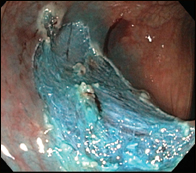 Complete resection after colonic EMR.