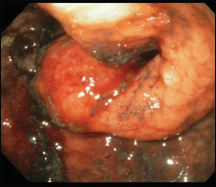 Figure 2. (A) Endoscopic image of the pylorus in a patient with malignant gastric outlet obstruction due to gastric cancer. The distal stomach has been completely infiltrated with malignant tissue, the pylorus is stenosed, and there is no functional peristalsis in the stomach. 