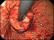 preoperative valves (A and C) and the same valves after the EsophyX TIF procedure (B and D).