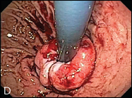 preoperative valves (A and C) and the same valves after the EsophyX TIF procedure (B and D).