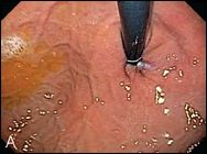 preoperative valves (A and C) and the same valves after the EsophyX TIF procedure (B and D).