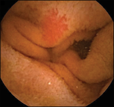 Angiectasia on capsule endoscopy.