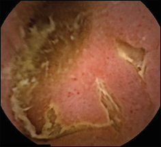 Deep, linear ulcers in Crohn’s disease on capsule endoscopy.