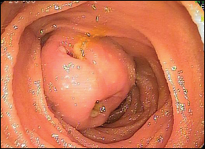 Submucosal tumor (GI stromal tumor) on double balloon enteroscopy.