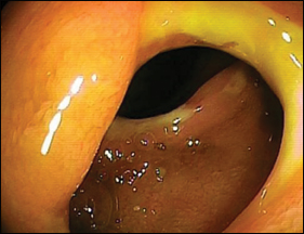 Ulcerated ileal Crohn’s strictures.