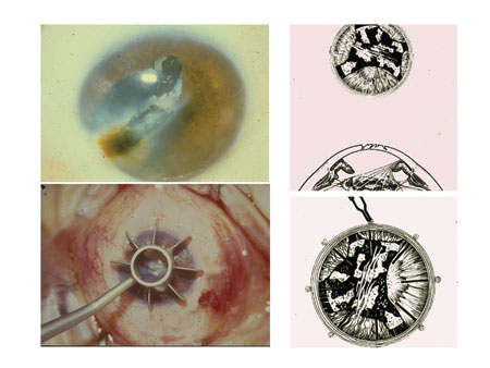 Figure 1. Keratoplasty and anterior segment reconstruction. 