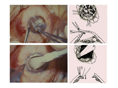 Figure 2. Keratoplasty and anterior segment reconstruction.