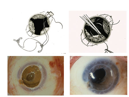 Figure 3. Keratoplasty and anterior segment reconstruction. 