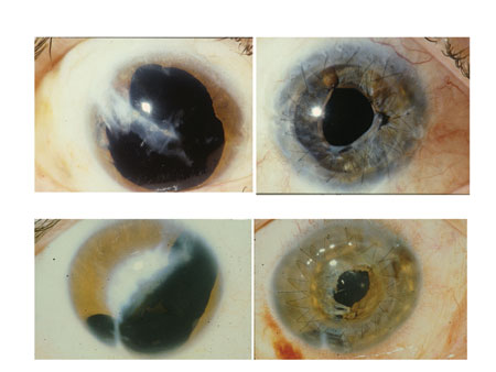 Figure 4. Selected cases of keratoplasty and anterior segment reconstruction.