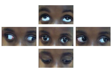 A left exotropia is seen on primary gaze, and synergistic divergence is seen as the left eye attempts to adduct.