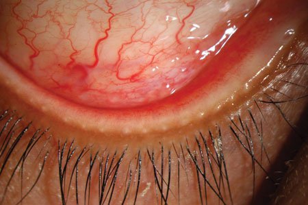 Inferior fornix of the right eye showing conjunctival injection and follicles. 