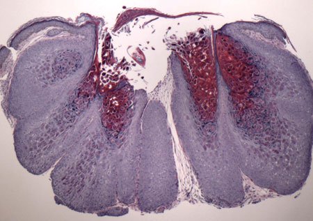 Hematoxylin and eosin stain of the right upper eyelid lesion