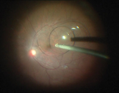 Vitrectomy for dropped IOL.