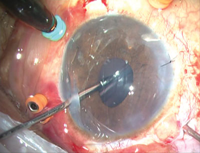 IOL brought anteriorly and haptic held with end-opening forceps.