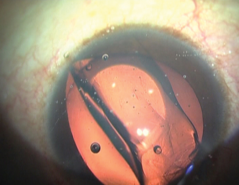 Posterior chamber phakic Visian ICL injected inside the eye.